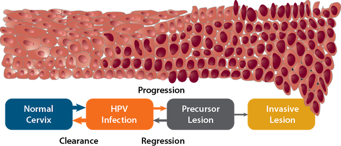Sidebar Figure (How HPV Infections Cause Cancer)