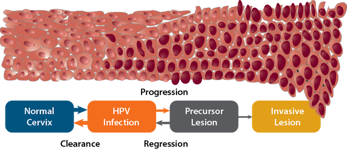 What Are Pearly Penile Papules?